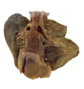 A child's lungs and windpipe, obstructed by a kernel of corn.