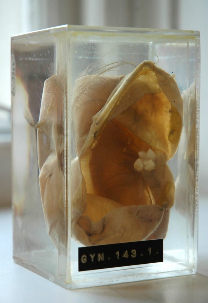 Teratoma with Tooth and Hair
