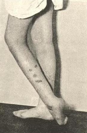 Image showing self-inflicted burns in a “hysterical” patient, from John Collie’s Malingering and Feigned Sickness (1913)